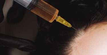 Injectie Hoofd Haarlijn Haartransplantatie 1